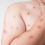 Mpox: África tem quase 50 mil casos confirmados